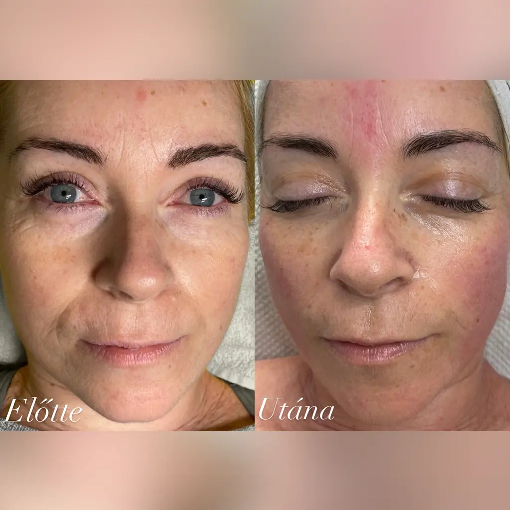 Age attraction - lézeres mezoterápia 1 age attraction pure