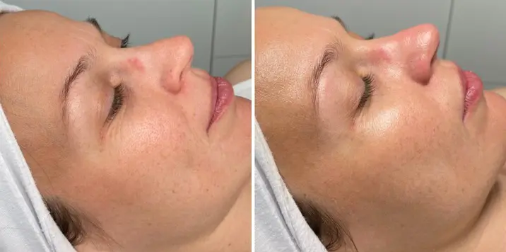 Carbon peeling arckezelés