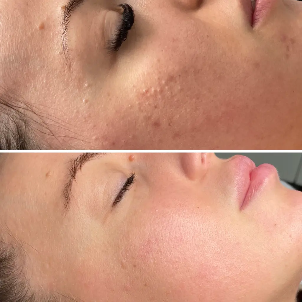 hydra touch kezeles elotte utana pure