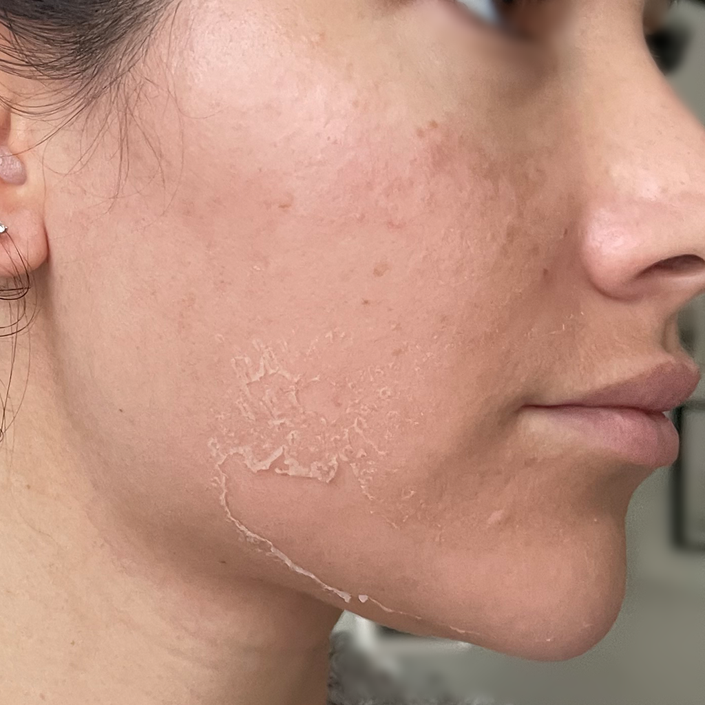 sqt kezeles utan kozvetlenul pure beauty