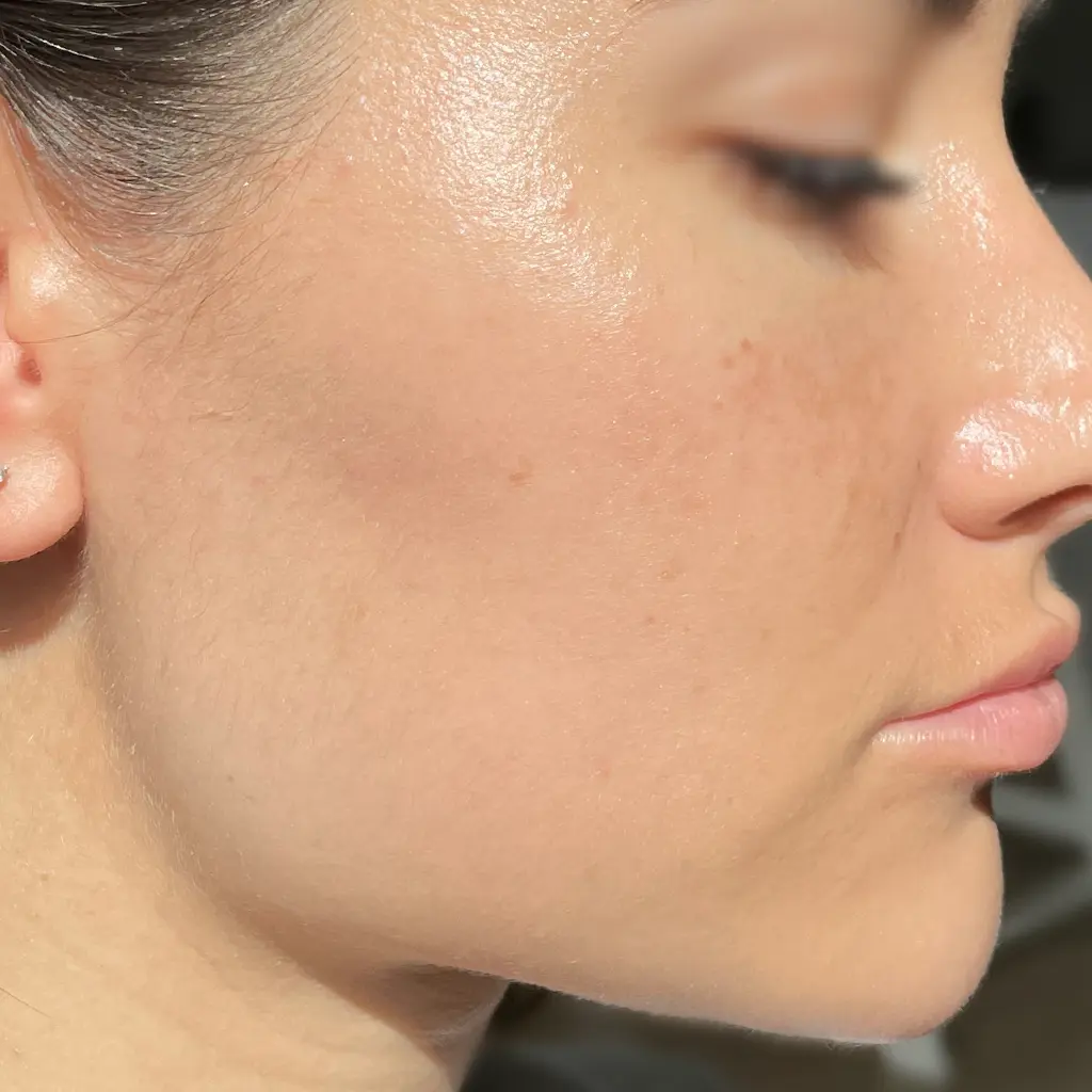 sqt kezeles utan pure beauty